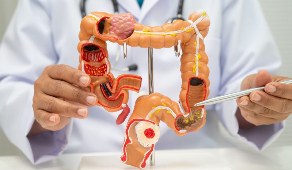 cáncer de colon