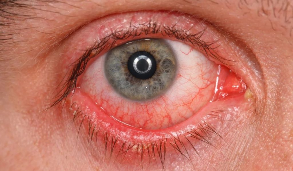 ojo rojo